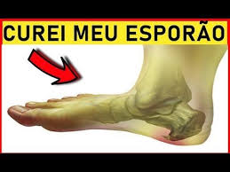 Calçados Para Quem Tem Esporão E Fascite Plantar Como Ficar Curado Do Esporao Pra Sempre Com Este Remedio Natural Youtube Como Curar Esporao Esporao Remedio Para Dor