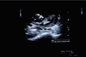 Nt screening test and the same time. First Trimester Scan The Nuchal Translucency Scan Cloudnine Blogyour First Trimester Scan Or Nuchal Translucency Scan
