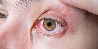 One or both eyes may. Uveitis Warum Eine Fruhzeitige Behandlung Wichtig Ist Aumedo