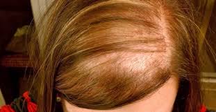 home remedies for hair loss health top priority losing hair women hair loss women thining hair