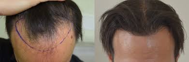 Da cosa dipende il costo dell'intervento? Trapianto Capelli Per Ridisegnare La Linea Frontale Livello 4