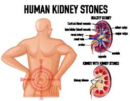 Kidney Stones Uromedix
