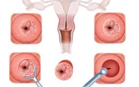 Este o realitate de care trebuie sa se tina cont si nu trebuie mers pe ideea ,,mie nu mi se poate intampla una. Cervicita Sau InflamaÅ£ia Colului Uterin Simptome Cauze Si Tratament Medical Tv
