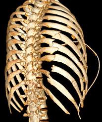 Image result for Flail Chest