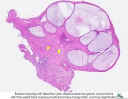 An endometrial polyp may go away on its own without treatment. Solfa Syllable Separacion Endometrial Polyp Endometrial Icd 10