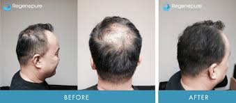 Nofap #hair #effects | this is what i did to stop hairfall queries solved: Nofap Cause Hair Loss
