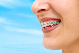 What Color Braces Should I Get Next Castilla Orthodontics