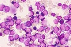 骨髄異形成症候群 診療の参照ガイド 3 緒言 骨髄異形成症候群（myelodysplastic syndromes：mds）は，血球の形態異常と無効造血を特徴 とする造血幹細胞腫瘍である．末梢血では血球減少をきたすが，その原因は無効造血であるため æ¤œæŸ»æŠ€å¸«ã®ãŸã‚ã®é›»è„³ è¡€æ¶²å½¢æ…‹å¡¾ ç—‡ä¾‹ 15 ãƒ™ãƒƒã‚¯ãƒžãƒ³ ã‚³ãƒ¼ãƒ«ã‚¿ãƒ¼