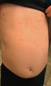 In folgenden fällen sollte die behandlung der scabies grundsätzlich aus zwei anwendungen bestehen: Skabies Erfahrungen Aus Der Praxis