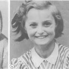 a, b, and c Baby, childhood, and adultfacies ofcase 13 showing typical...