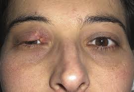 An eyelid is a thin fold of skin that covers and protects an eye. Upper Eyelid Reconstruction With Forehead Galeal Flap Journal Of Plastic Reconstructive Aesthetic Surgery