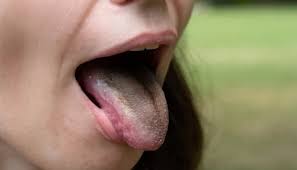 Image result for black tongue symptoms