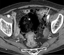 Are you preparing to have this procedure soon? Scielo Brasil Differentiation Between Stercoral Perforation And Colorectal Cancer Perforation Differentiation Between Stercoral Perforation And Colorectal Cancer Perforation