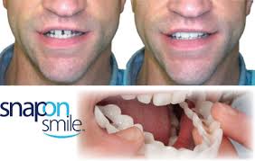 Porcelain veneers have become popular in recent years. 4excellence In Dentistry Cosmetic Snap On Smiles In Levittown 11756 4excellence In Dentistry