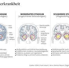 Das umfassendste symptom der alzheimer erkrankung ist der fortschreitende gedächtnisverlust mit zunehmender vergesslichkeit. Gen Des Vergessens Die Grossfamilie Deren Schicksal Alzheimer Ist Welt