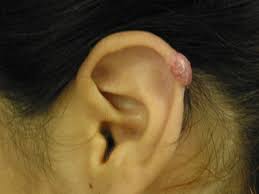 Image result for Keloid