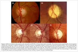 Image result for Optic Neuritis