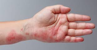 Este microscopic mic, dar foarte viclean. Zona Zoster Afectiune De Piele Dr Leventer Centre