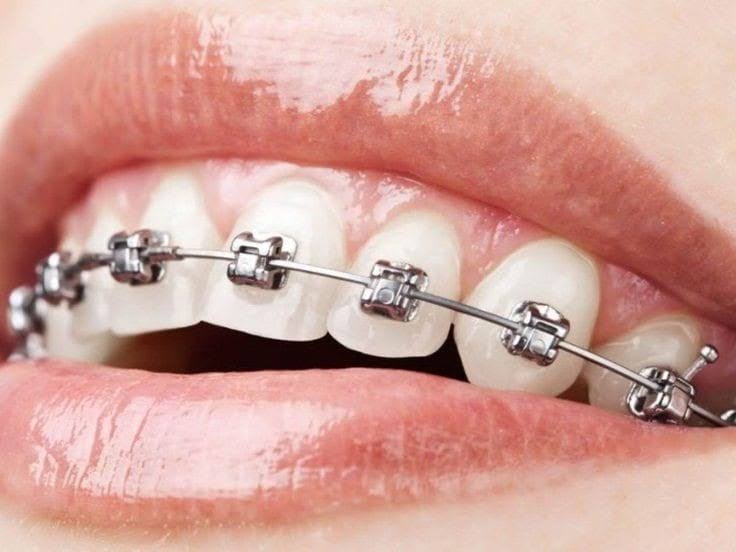 METAL BRACE product image