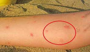 Setiap perubahan pada kulit tampak jelas, terlepas dari gejala mereka yang bersamaan. Cara Ampuh Menghilangkan Bekas Gigitan Nyamuk Secara Alami Arbamedia Com