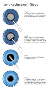 Image result for Cataract Extraction