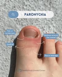 Image result for Paronychia feet