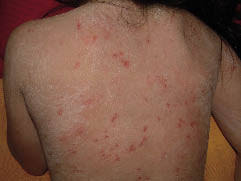 Sjogren Larsson Syndrome A Study Of Clinical Symptoms And Dermatological Treatment In 34 Swedish Patients Html Acta Dermato Venereologica