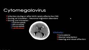 Pin By Dr Abuaiad On Brain Head And Neck Cns Mental Retardation 2nd Trimester
