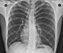 Naskolko Tochny Rezultaty Flyuorografii Pri Diagnostike Pnevmonii I Bronhita Detskaya Stomatologicheskaya Poliklinika G Penza
