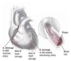 The following people are more likely to be affected: Heart Attack Myocardial Infarction Harvard Health