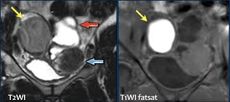 A pelvic examination or imaging tests like a pelvic ultrasound or computerized tomography (ct) scan. The Radiology Assistant Endometriosis Mri Detection