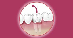 Image result for Tooth Extraction
