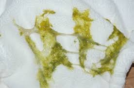 4 los parásitos intestinales causan mocos fecales. Heces Con Moco Con Sangre En Ninos Es Normal Botar Un Flujo Amarillo En El Embarazo