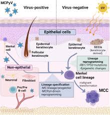 Image result for Merkel Cell Carcinoma