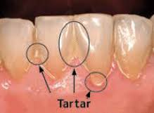 Dental plaque leads to tartar buildup what causes dental plaque and tartar? Resource Center Archives Page 2 Of 6 Pasha Dental
