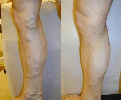 Varicose vein treatment tricare may cover the following services and supplies to treat saphenous venous reflux with symptomatic varicose veins and/or incompetent perforator veins: Varicose Vein Treatment Riverside Radiology And Interventional Associates