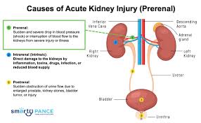 Image result for Postrenal Failure