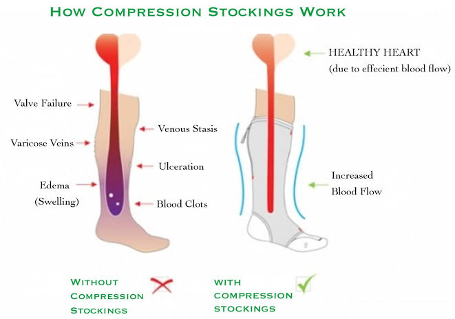 How compression socks support healthy blood flow, AI generated