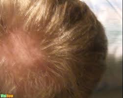 If you start losing hair on the spots on your scalp where you see red and purple bumps and scars, seek evaluation, as it could be due to a scarring hair loss, such as lupus or lichen perform a patch testto ensure no adverse reactions occur. Stop Bald Patches Caused By Stress Related Hair Loss Visihow