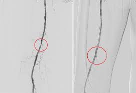 Ce inseamnă operaţia de montare a unui stent libertatea. Srcv Angioplastia Si Stentarea