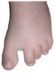 Abnormal Gait ExaNeuropathic Gait Demonstration