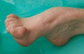 Later they can also have hand weakness and sensory loss. Do Fluoroquinolone Antibiotics Trigger Charcot Marie Tooth And Other Genetic Diseases Hormones Matter