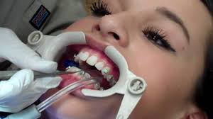 Pin On Do Braces Hurt