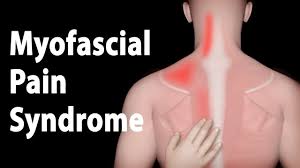 This procedure is one of the most powerful yet simple ways to treat muscle pain and discomfort. Myofascial Pain Physiopedia