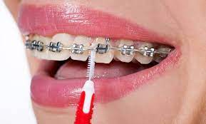 While you have braces, use a waterpik® water flosser in addition to a sonic toothbrush. Care And Maintenance Of Braces Dr Firouzian In Columbus Oh