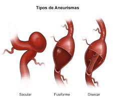 El objetivo del tratamiento es controlar los síntomas y prevenir futuros sangrados. Cerebral Aneurysm
