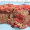 I was diagnosed with colon cancer, stage 2 on september 20, 2016, after having had a colonoscopy. 1