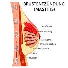 Brustentzundung Mastitis Ursachen Symptome Behandlung