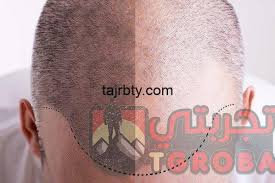 متى تثبت البصيلات بعد زراعة الشعر تجربتي