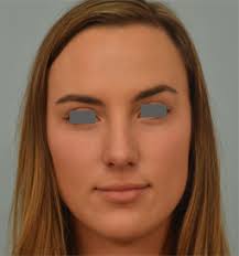 If on the other hand you have a nose infection: What Are Spreader Grafts Dr Grigoryants Reviews Spreader Graft Use In Rhinoplasty Rhinoplasty Los Angeles Best Nose Surgery Options Dr Grigoryants